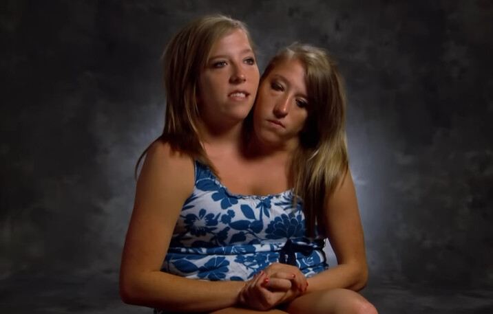 Дві жінки живуть в одному тілі: історія Еббі та Брітані Гензел